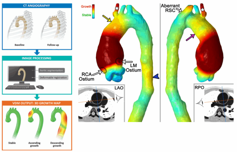 Research – Advanced Aortic Imaging for Clinical and Translational ...